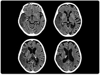 Компьютерный томограф Canon Aquilion RXL