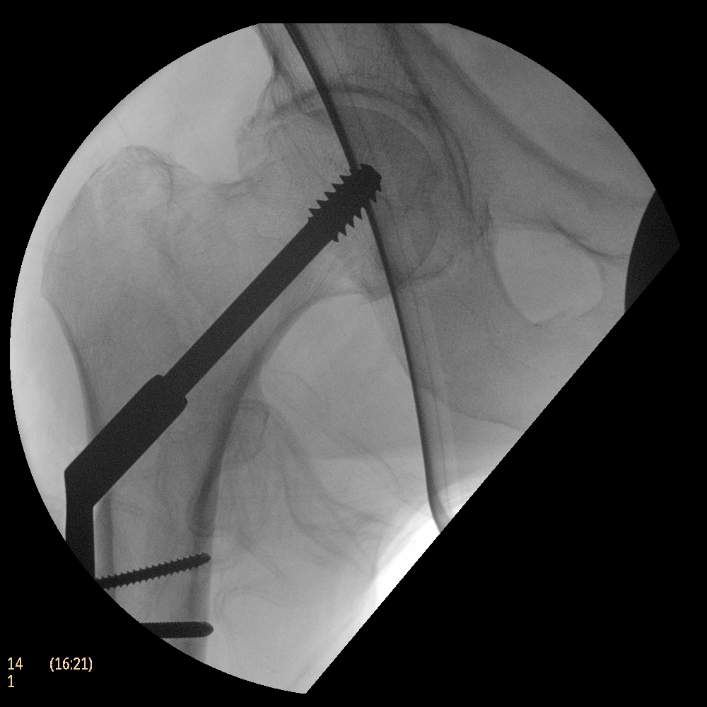 Флюороскопическая рентгеновская система с С-дугой Philips BV Endura