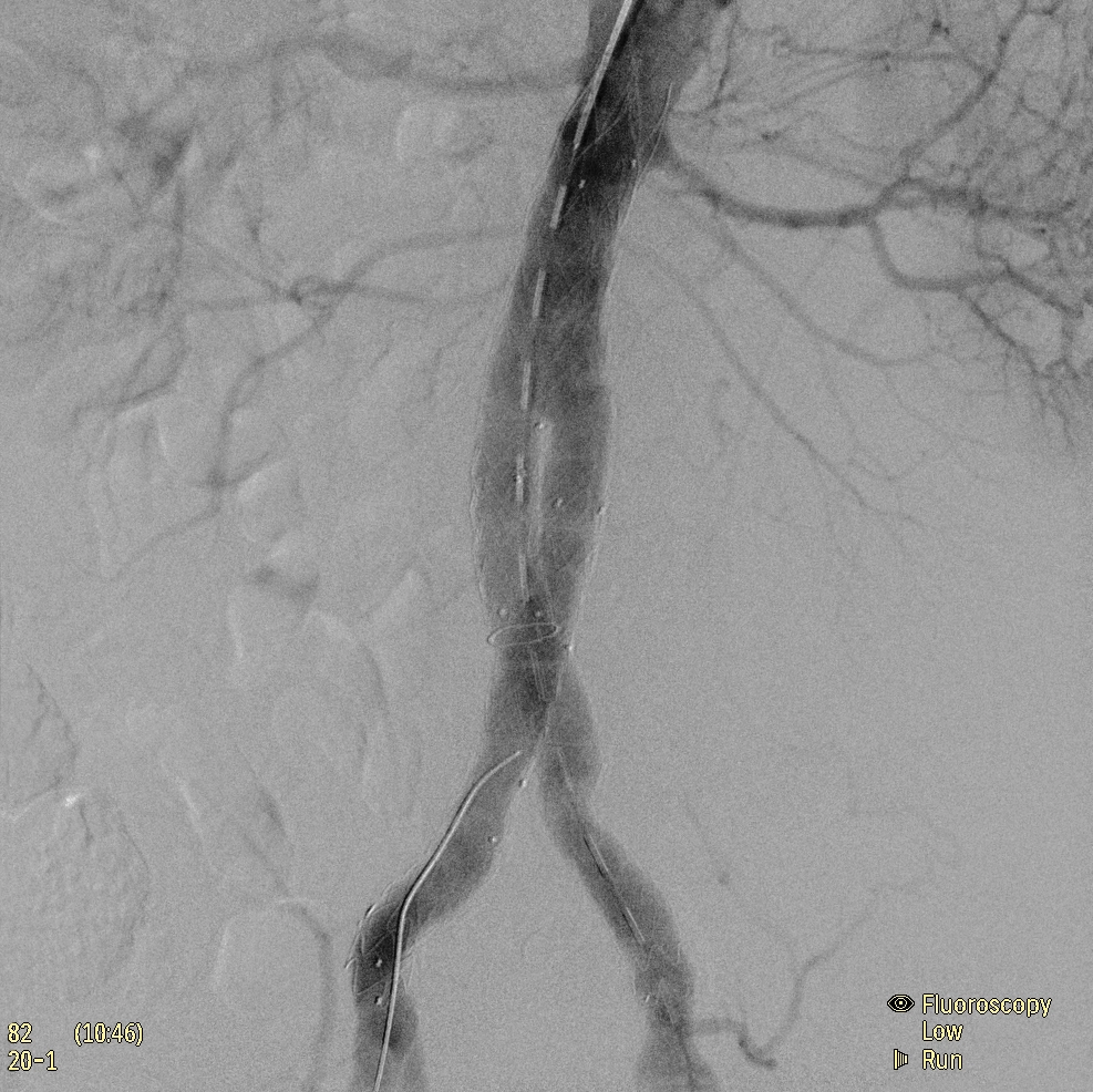 Флюороскопическая рентгеновская система с С-дугой Philips Zenition 70