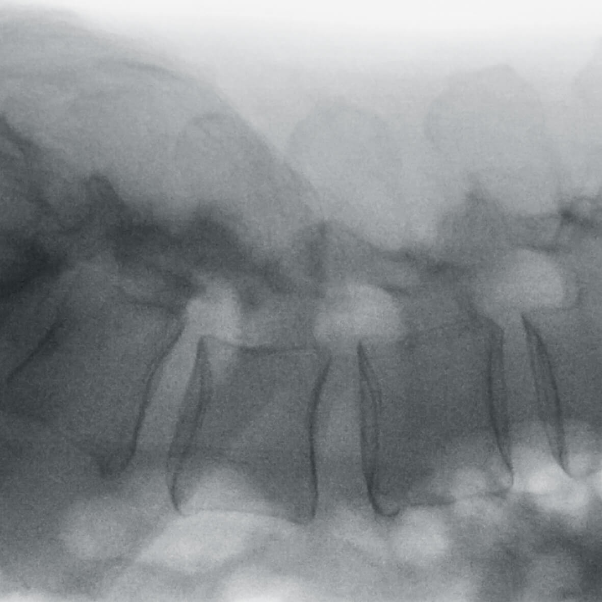 Передвижная рентгеноскопическая система Ziehm Vision RFD