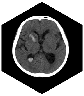 Компьютерный томограф SinoVision Insitum 64S