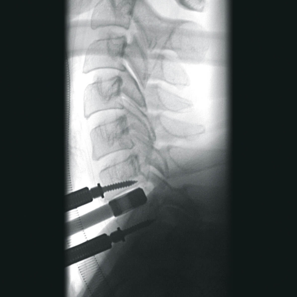 Передвижная рентгеноскопическая система Ziehm Vision RFD 3D