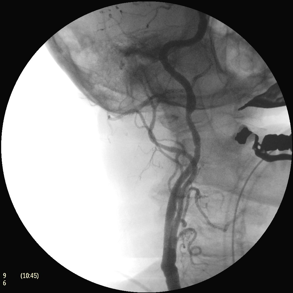 Флюороскопическая рентгеновская система с С-дугой Philips Zenition 50