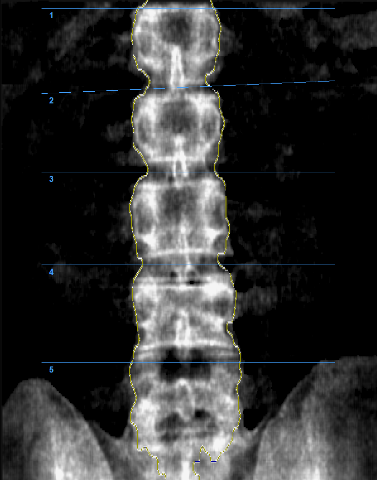 Денситометр рентгеновский Medikors InAlyzer AIR