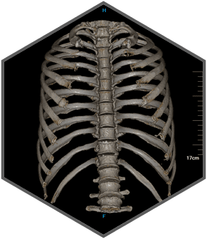 Компьютерный томограф SinoVision InsitumCT 338