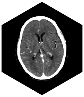 Компьютерный томограф SinoVision Insitum 32