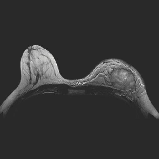 Матричная катушка для молочных желез Siemens Breast Matrix Coil