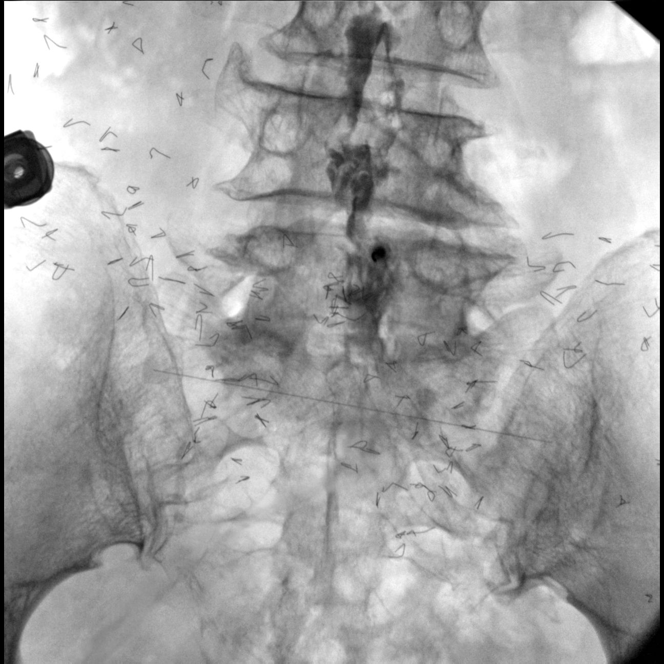 Гелпик «РЕНЕКС» 15 кВт мобильный рентгенохирургический аппарат типа С-дуга С.П. с плоскопанельным детектором