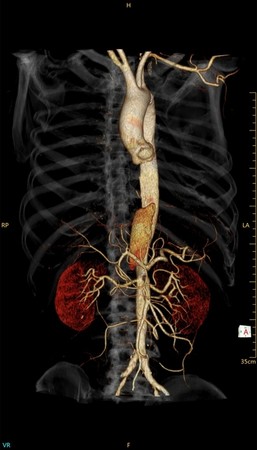 Компьютерный томограф NeuViz Prime