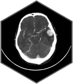 Компьютерный томограф SinoVision InsitumCT 338