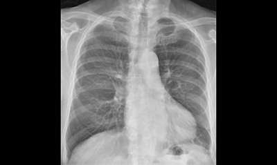 Цифровой рентгеновский аппарат Philips ProGrade