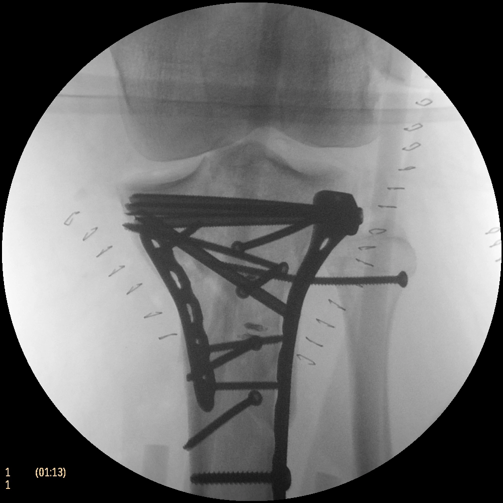 Флюороскопическая рентгеновская система с С-дугой Philips Zenition 50