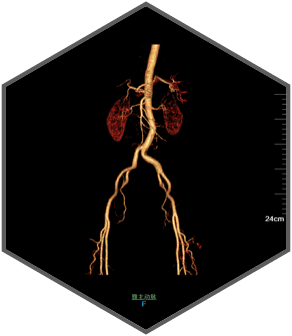 Компьютерный томограф SinoVision InsitumCT 338