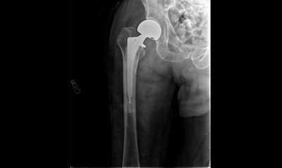 Цифровой рентгеновский аппарат Philips ProGrade