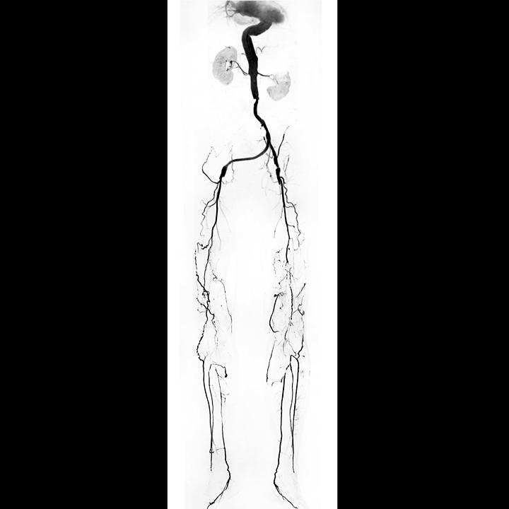 Катушка для ангиографии периферических сосудов Siemens Peripheral Angio 36