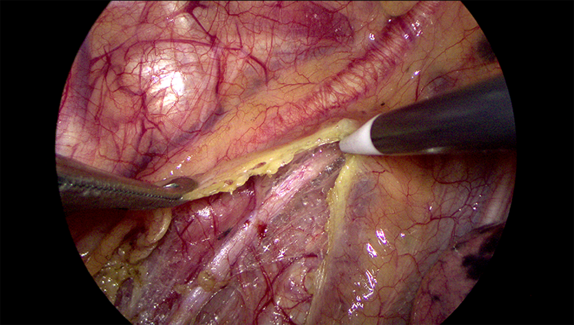 Mindray HyPixel U1 эндоскопическая видеосистема 4K ULTRA HD