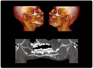 Компьютерный томограф Canon Aquilion RXL