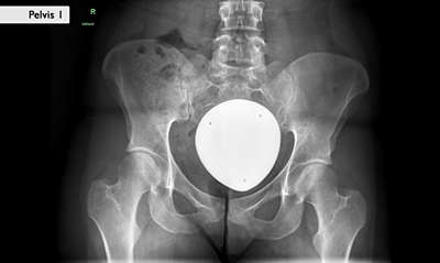 Цифровой рентгеновский аппарат Philips FlexiDiagnost