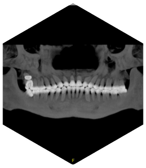 Компьютерный томограф SinoVision Insitum 64