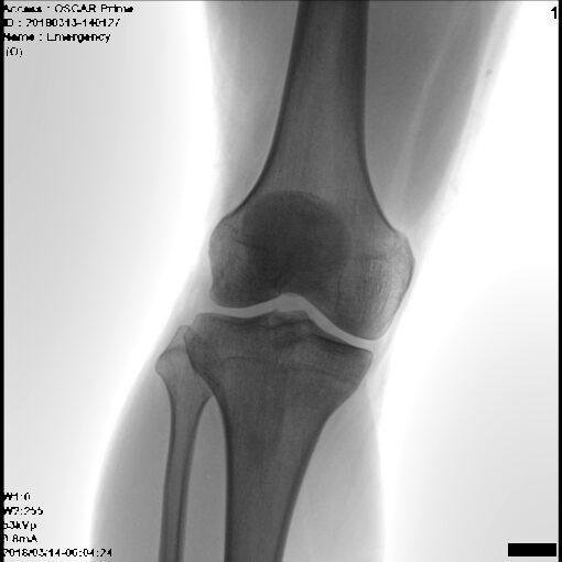 С.П. Гелпик «РЕНЕКС» 5,3 кВт мобильный рентгенохирургический аппарат типа С-дуга с плоскопанельным детектором