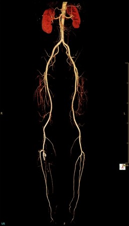 Компьютерный томограф NeuViz Prime