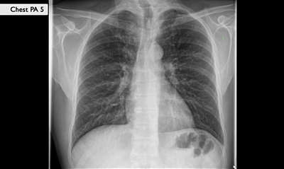 Цифровой рентгеновский аппарат Philips FlexiDiagnost