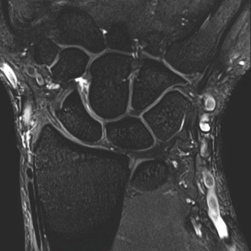 8-канальная катушка на запястье Siemens 8-Channel Wrist Coil