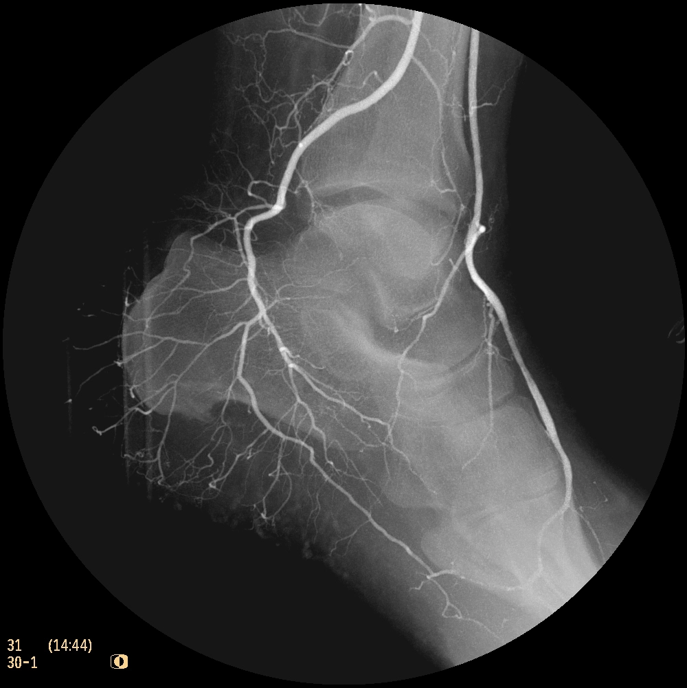 Флюороскопическая рентгеновская система с С-дугой Philips Zenition 50