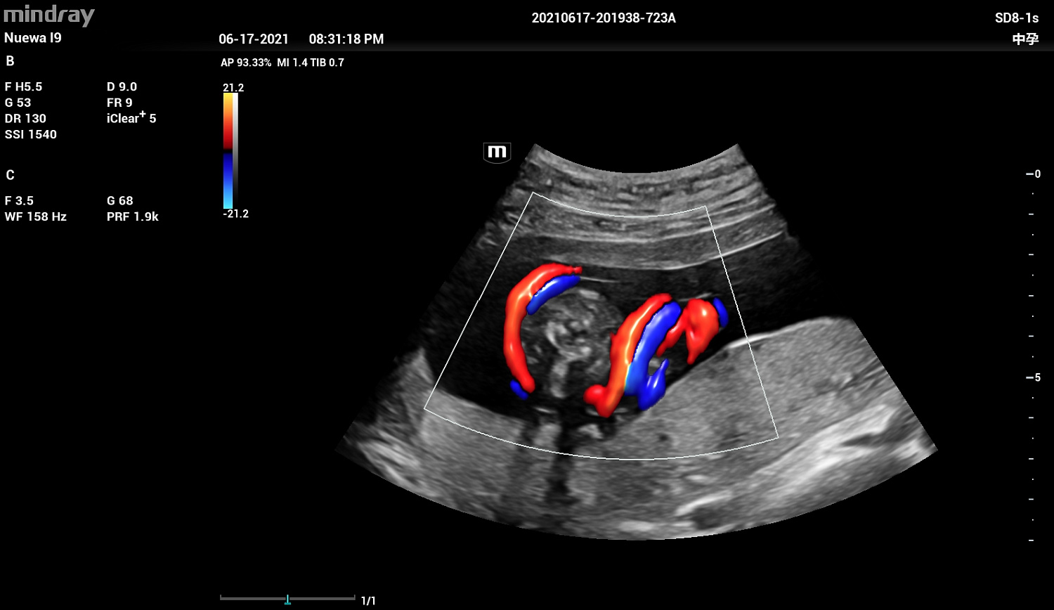 Ультразвуковой аппарат Mindray Imagyn I9