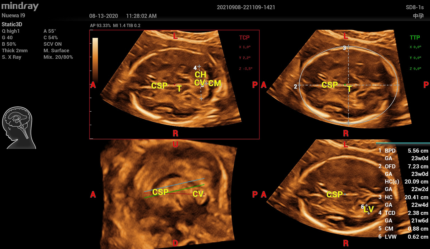 Ультразвуковой аппарат Mindray Imagyn I9