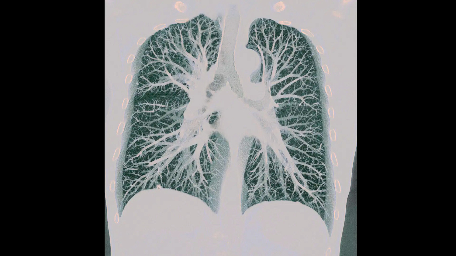 Компьютерный томограф Siemens NAEOTOM Alpha