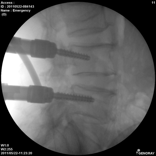С.П. Гелпик «РЕНЕКС» 5,3 кВт мобильный рентгенохирургический аппарат типа С-дуга с цифровым УРИ