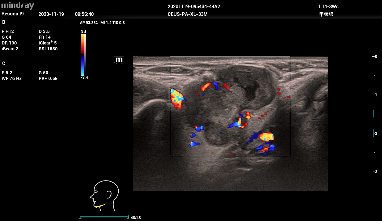 Ультразвуковой аппарат Mindray Resona I9