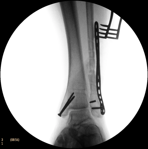 Флюороскопическая рентгеновская система с С-дугой Philips Zenition 50