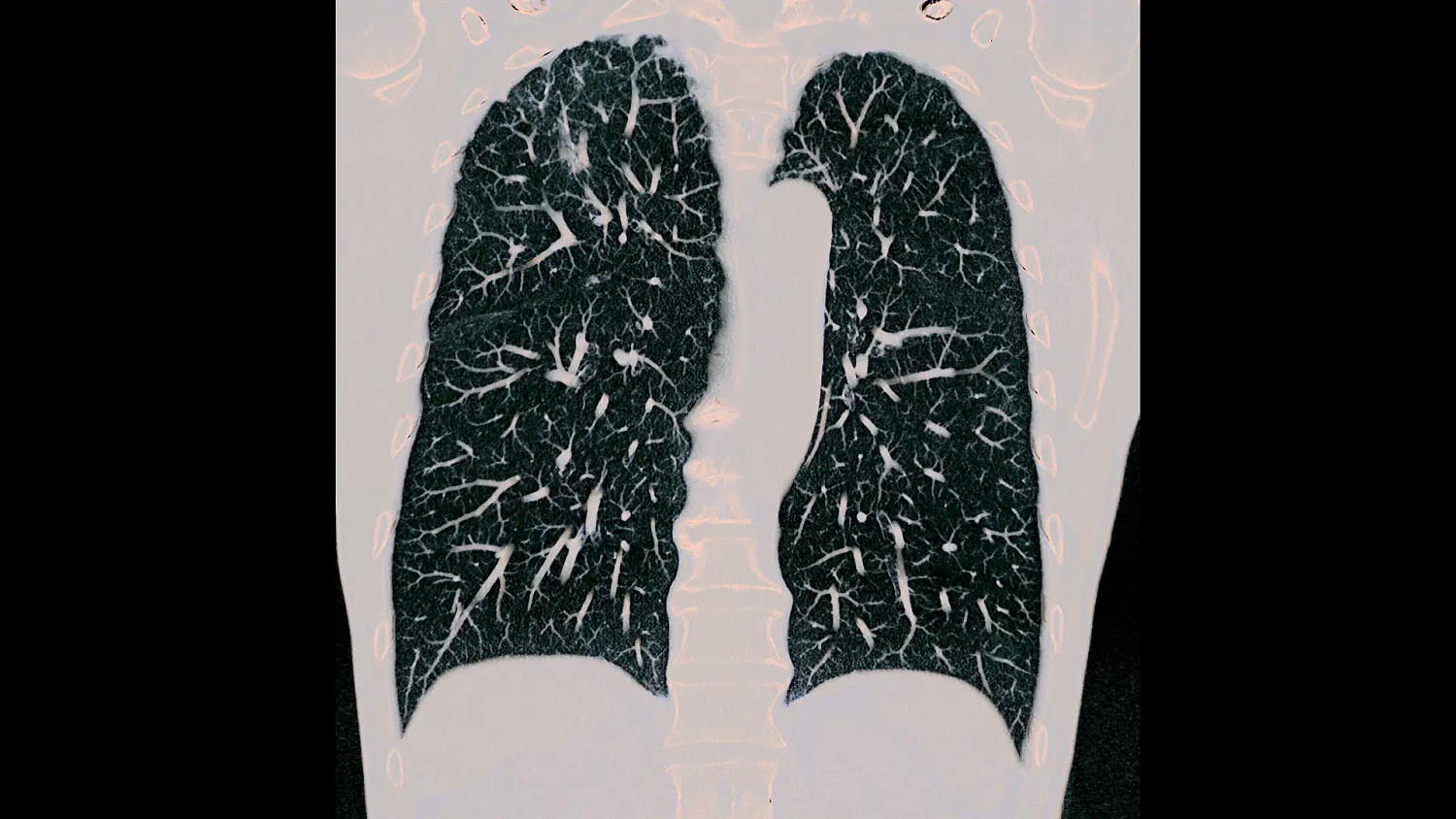 Компьютерный томограф Siemens NAEOTOM Alpha