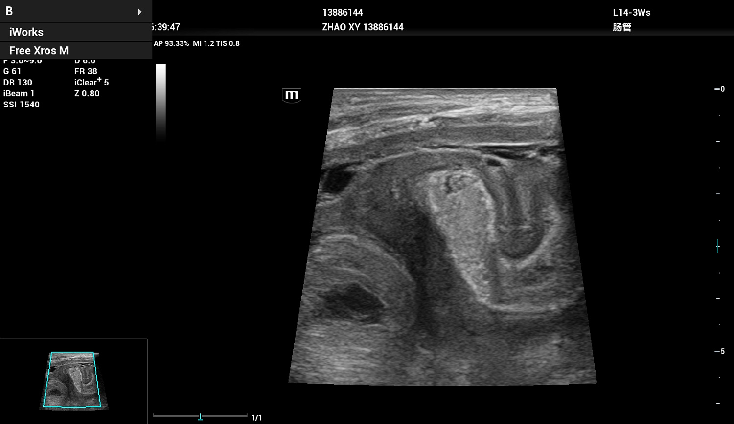 Ультразвуковой аппарат Mindray Resona I9