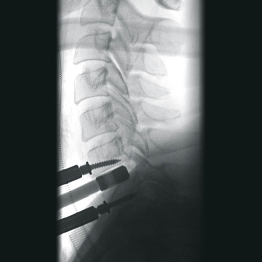 Передвижная рентгеноскопическая система Ziehm Vision RFD 3D