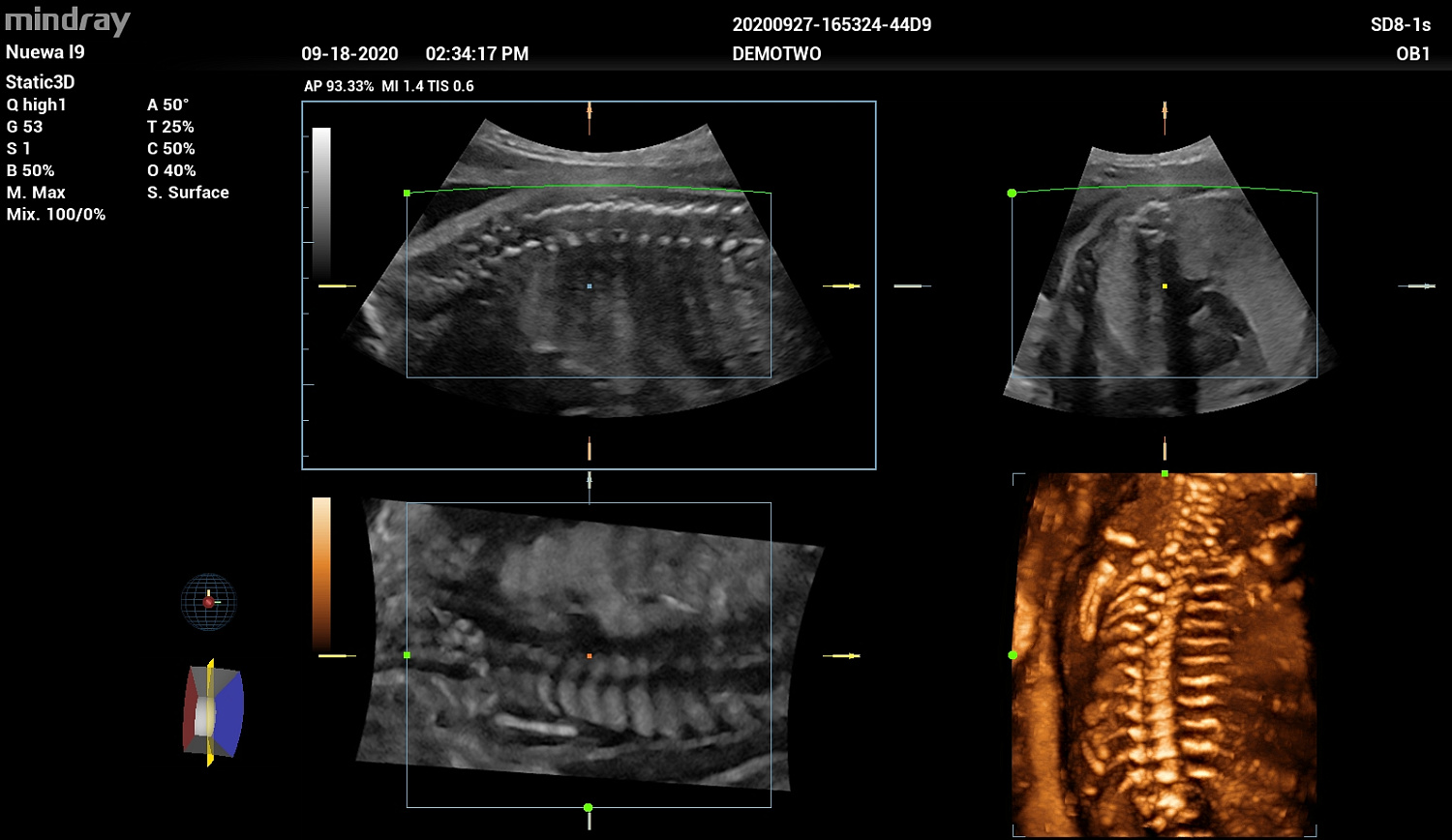 Ультразвуковой аппарат Mindray Imagyn I9