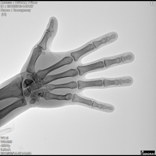 С.П. Гелпик «РЕНЕКС» 5,3 кВт мобильный рентгенохирургический аппарат типа С-дуга с плоскопанельным детектором