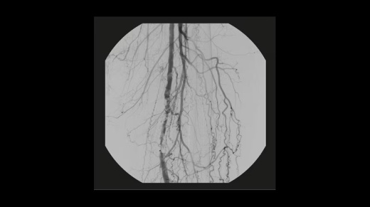 Мобильный рентгеновский аппарат с С-дугой GE OEC Elite CFD