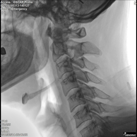 С.П. Гелпик «РЕНЕКС» 5,3 кВт мобильный рентгенохирургический аппарат типа С-дуга с плоскопанельным детектором