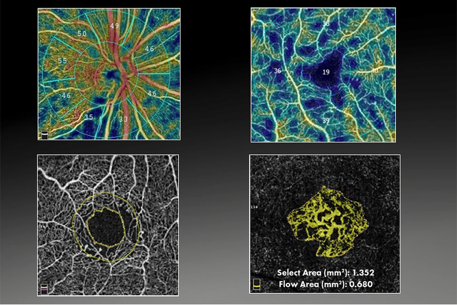 Optovue SOLIX