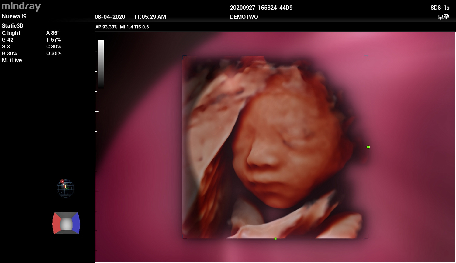 Ультразвуковой аппарат Mindray Imagyn I9