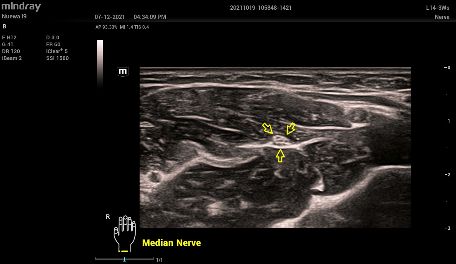 Ультразвуковой аппарат Mindray Resona I9