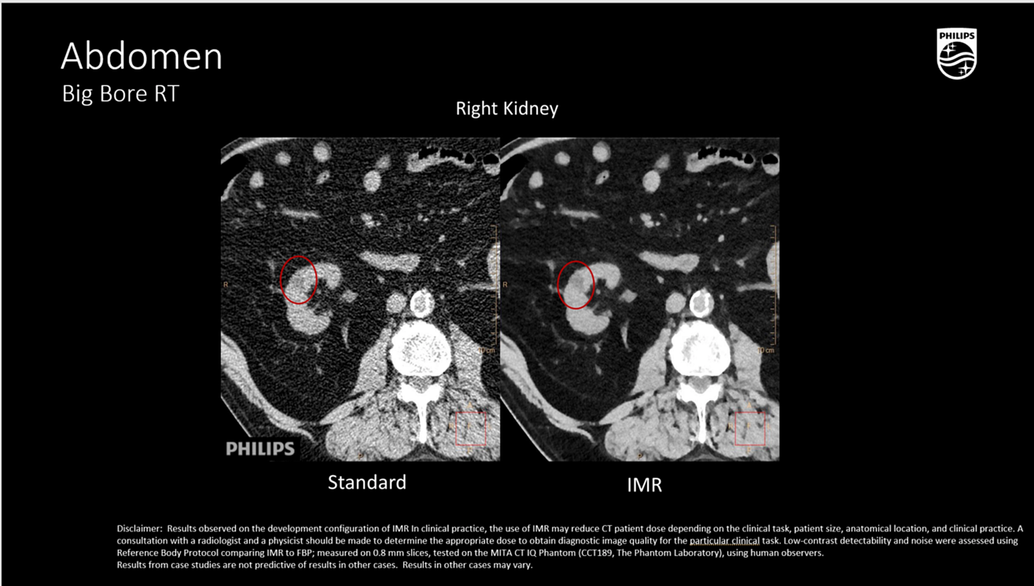 Компьютерный томограф Philips CT Big Bore