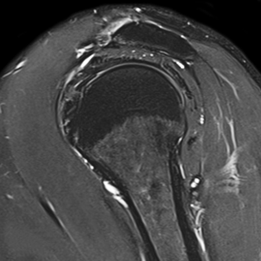 Катушка для плеча Siemens Shoulder Large 16, Shoulder Small 16