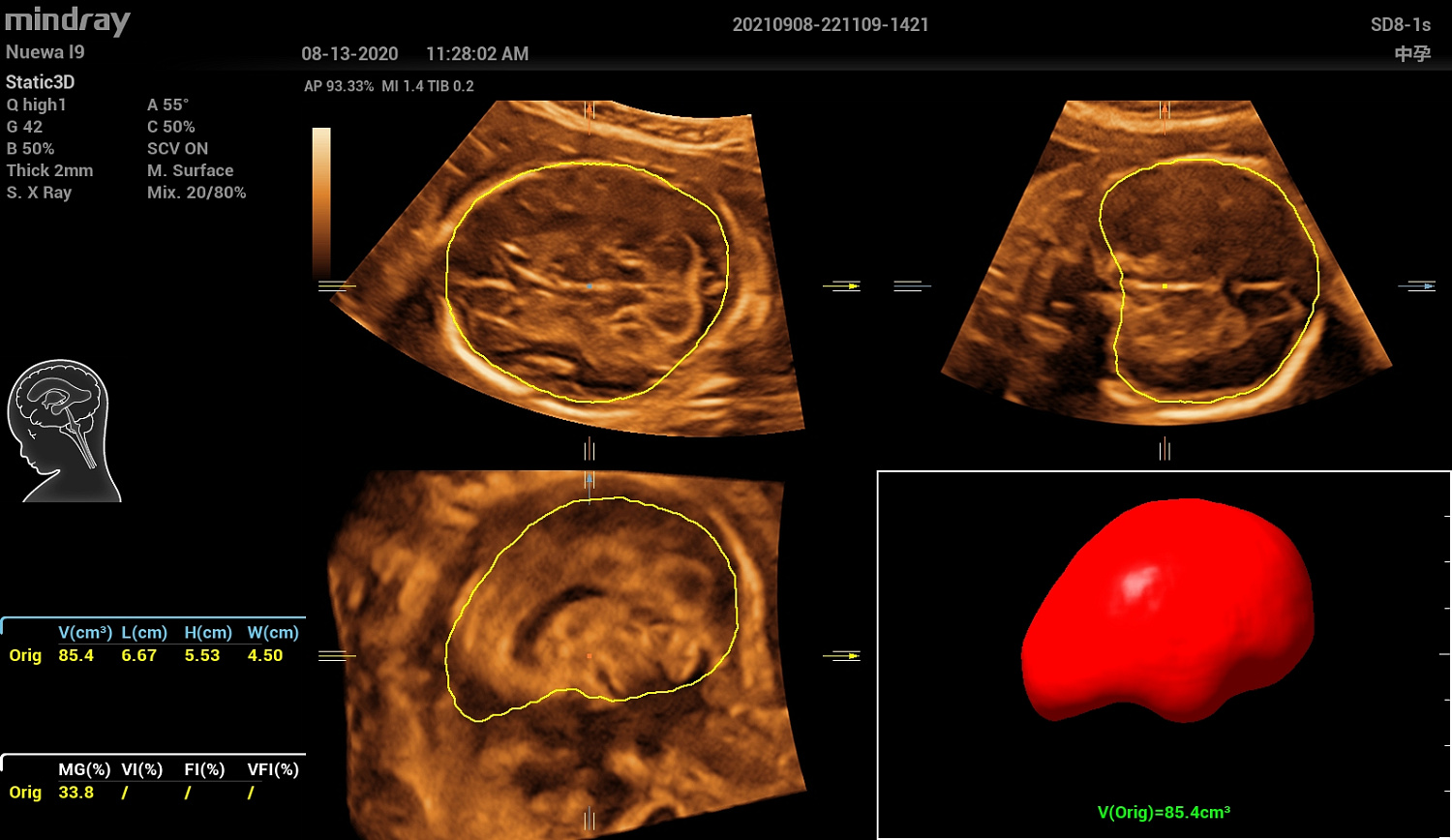 Ультразвуковой аппарат Mindray Imagyn I9