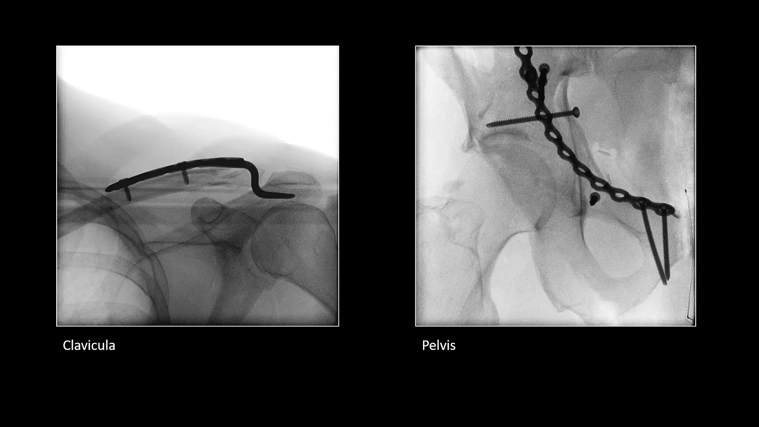 Мобильный рентгеновский аппарат с С-дугой Siemens Cios Select
