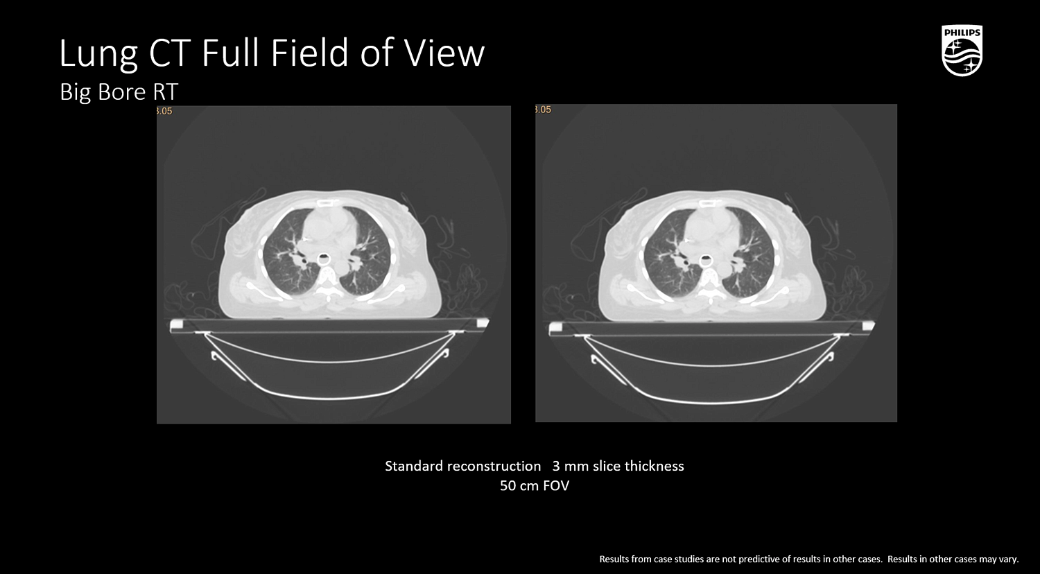 Компьютерный томограф Philips CT Big Bore