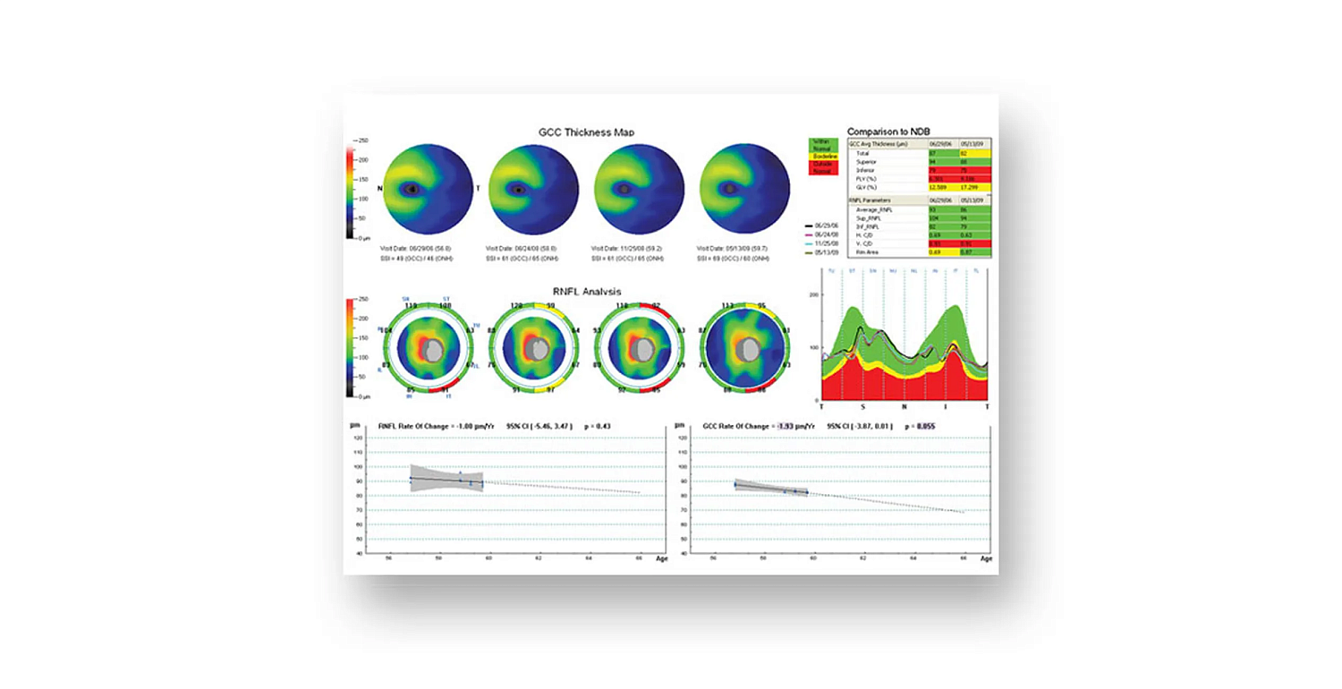 Optovue iScan